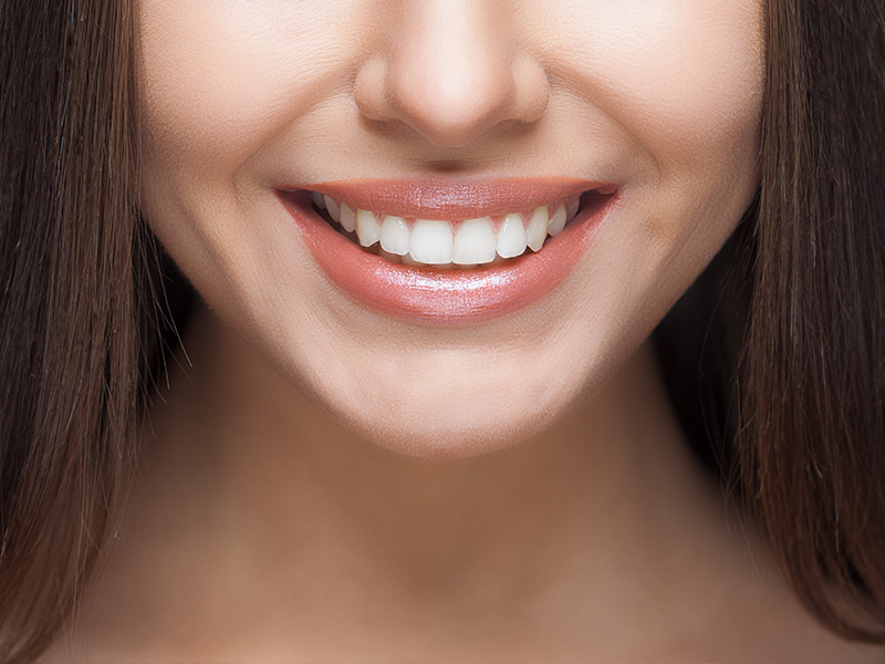 הלבנת שיניים בקריות, השאיפה לחיוך מדהים - רוי דנט