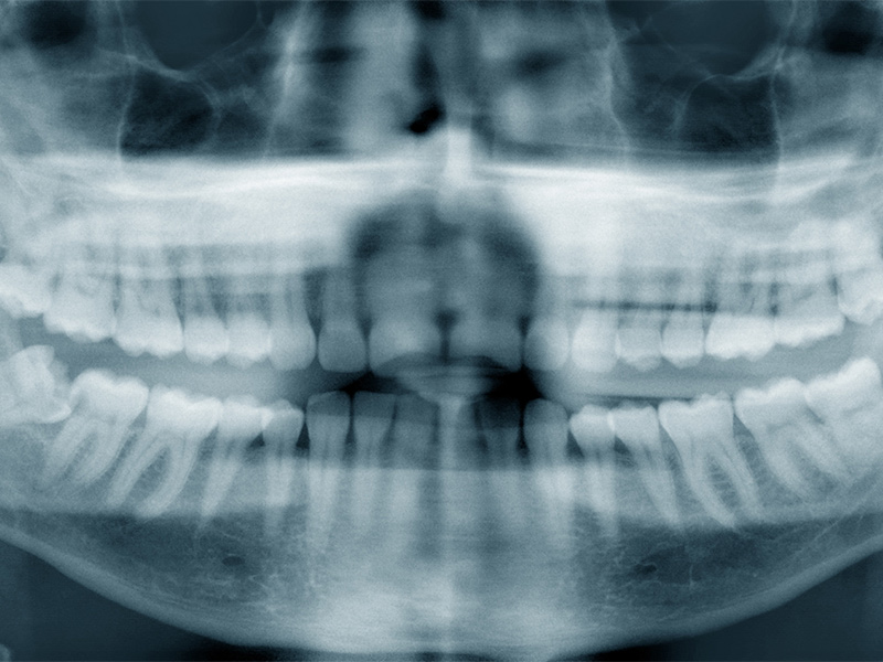 צילום שיניים בקריות, צילום פנורמי המביא עמו מהפכה - רוי דנט
